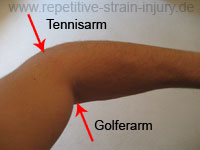 Tennisarm und Golferarm